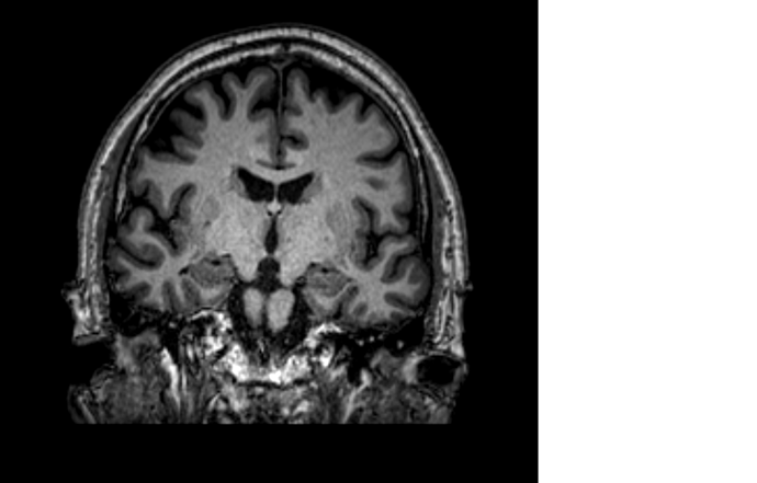 mri