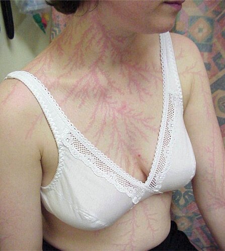 lightning-strike-scar-lichtenberg-figure-1