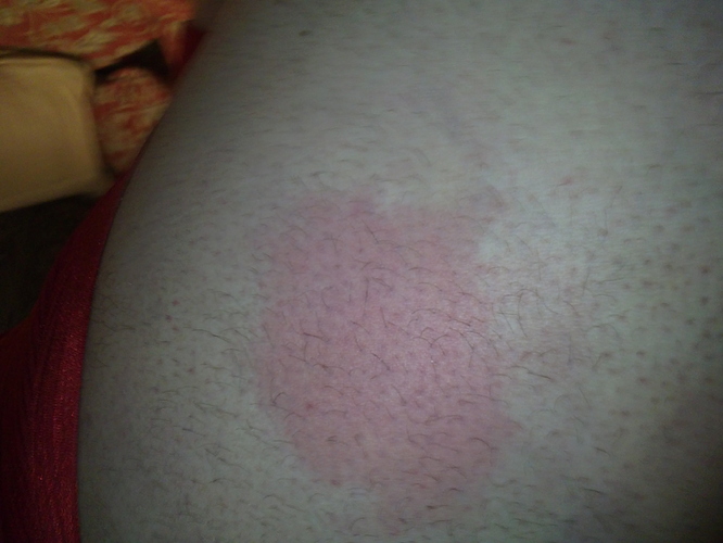 Lump After Last Injection Pharma / TRT T NATION